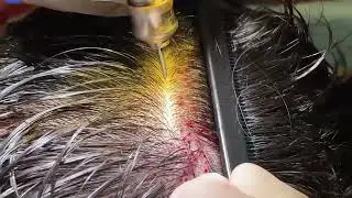 Long hair FUE by Dr.Tayfun Oguzoglu at DrT Clinics