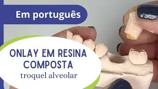 Onlay em resina composta - parte 3: troquel alveolar.