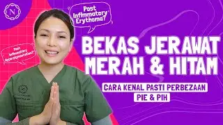 Beauty Tips || Bekas jerawat jadi MERAH dan HITAM? Apakah punca dan perbezaanya PIE dan PIH?
