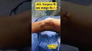Super Strong Knee After ACL Surgery 💥