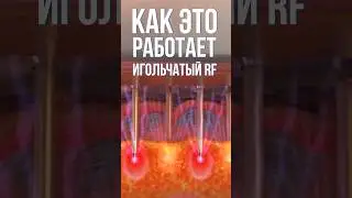 Как работает игольчатый rf? Что получаем в итоге? Полное видео тут. Жми #косметолог #shorts