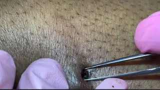 LEG EXTRACTION REMOVAL PART 2 Ep.10