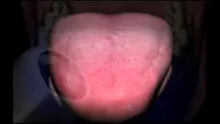 Tongue Cleaning - Miskin Ajax Dental