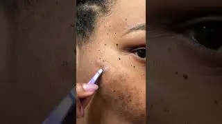 Pimple Patch Chronicles | skin update #omg #pimplepatch