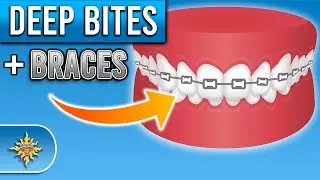 How Do Braces Fix Deep Bites? | Premier Orthodontics