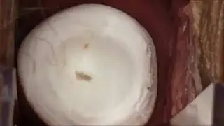 CRIOTERAPIA  INDICACIONES . DR, JAVIER OVIEDO V  . NICARAGUA