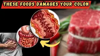 8 Most Harmful Foods For Your Colon | Worst Foods For Colon Health
