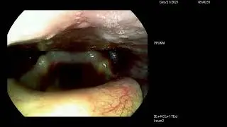 Videostroboscopy