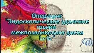 Операция. Эндоскопическое удаление грыжи межпозвонкового диска L5-S1. Нейрохирургия