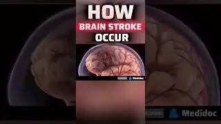 How Brain Stroke 🧠 Occur !