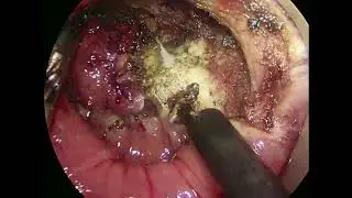 The role of TAMIS for low rectal lesions: An important tool for sphincter preservation