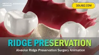 Alveolar Ridge Preservation 3D Medical Animation | Dental Surgery