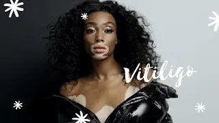 Tratamento? 50tons: Todas as dicas de Tratamento para Vitiligo