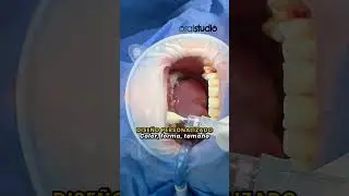 ¡Dile adiós al trauma en la colocación de implantes dentales! 🦷✨