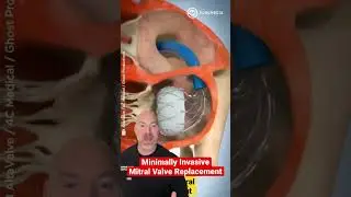 Replacing a Heart Valve 🫀 