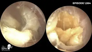 1,554 - White Shiny Dead Skin Plug Extraction