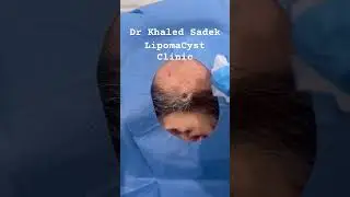 Let’s get it on #skincare #blackheadremoval dr Khaled Sadek