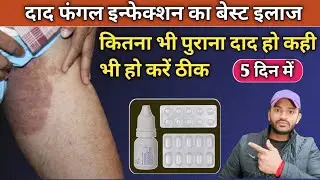 दाद फंगल इन्फेक्शन को करे सिर्फ 5 दिन में खत्म l