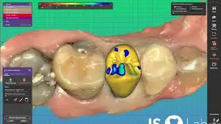 CAD/CAM - 3D modeling of the crown in the dental lab