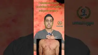 சருமத்தை பாதிக்கும் தன்னுடல் தாக்கு நோய்|Pemphigus vulgaris causes|Pemphigus treatment|Skin blisters