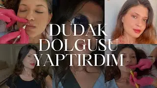 İlk Defa Dudak Dolgusu Yaptırdım! 👄