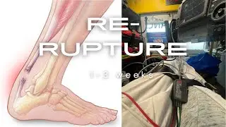 RE-Rupture Achilles Tendon (1-3 weeks) post surgery