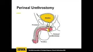 Core Videos (2021): Perineal Urethrostomy