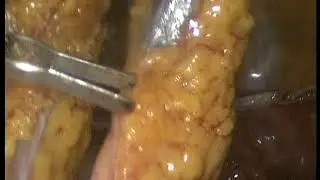 Пограничные опухоли