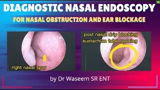 Diagnostic Nasal endoscopy | evaluation for nasal obstruction and ear blockage