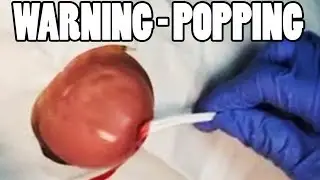 What is a this Back Growth?   World's Largest Pops & Blemishes