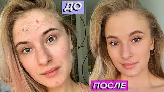 HOW TO GET RID OF ACNE | THE REAL WAY