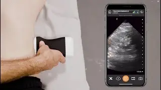 USG Point of Care para Avaliação de Hidronefrose