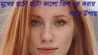 Soto soto kalo til dur korar sohoj upay | Remove Moles Skin | Til |