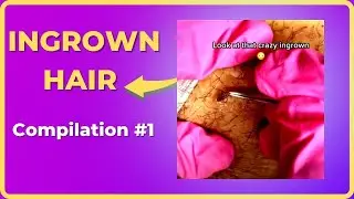 Ingrown Hair [ Top 10 Super Zoom ]