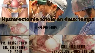 Hysterectomie extra-fasciale avec annexectomie bilatérales en deux temps / extrafascial hysterectomy