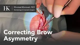 Correcting Brow Asymmetry: V to Y Repair Technique Explained by Dr. Hooman Khorasani