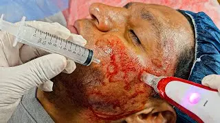 DERMAPEN + PLASMA RICO en PLAQUETAS 🔥 LO MEJOR en CICATRICES de ACNÉ y ANTIEDAD?