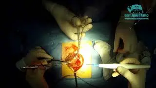 Corrección de hernia umbilical con técnica de mayo