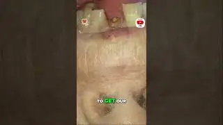Crown Dislodged  How to Identify a Fractured Tooth!