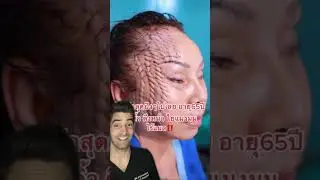 Scarless Facelift