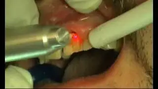 LÁSER DENTAL EN EMPASTES: odontología restauradora