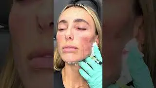 Polynucleotides to lift the face! #facialrejuvenation #jawlinecontouring #jawlinefiller