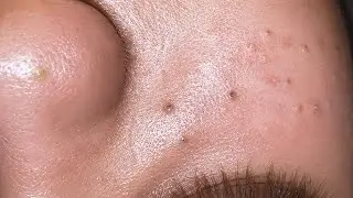 Ultimate [ASMR] Deep Pore Cleansing & Blackhead Removal – So Satisfying!
