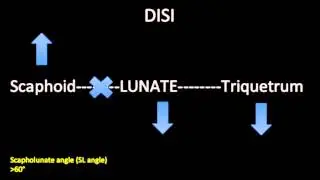 DISI and VISI abnormalities of the Wrist