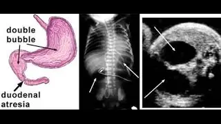 Duodenal Atresia