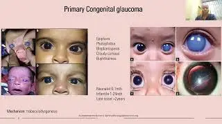Lecture: An Approach to the Juvenile Patient With Glaucoma