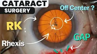 Cataract Surgery after Radial Keratotomy | Light Adjustable Lens or IC8 Apthera?