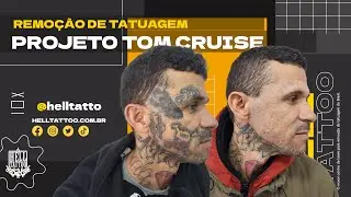 O Biller esta de volta ao projeto Tom Cruise | Remoção de Tatuagem