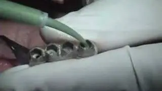 Lower posterior implant supported teeth