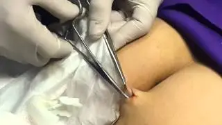 Butt Cyst
